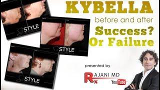 Watch Kybella Injection // Before and Afters -Fat Double Chin Reduction