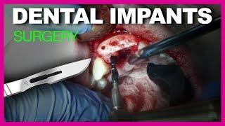 Dental Implant (after bone block)