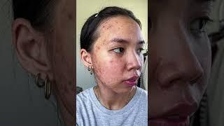 acne journey 🫶 #shorts #acne #acnejourney #acneproneskin #acnetreatment