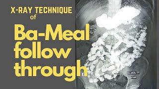 Technique of Barium meal follow through(Ep-48) | Ba-Meal Stomach & Duodenum