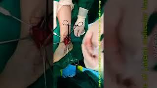 S6.Lateral malleolar fracture reduction technique, using with Kocher clamp (for Osteoporosis pts.)