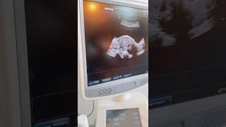 Перенос эмбриона под контролем УЗИ #ксм #экопоомс #бесплодие #baby #эко