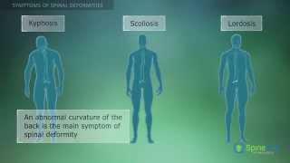 Spinal Deformities. Symptoms