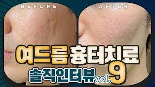 여드름흉터 6회 치료 후 경과 9번째편. 네이버 피부인 체험단