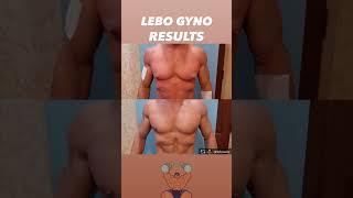 GYNECOMASTIA SURGERY RESULTS #beforeandafter #gynosurgeon #antiaging #transformation #aesthetic