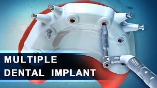 Dental Implant | Advanced Multiple  | 3d  Dental Animation