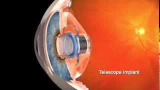 CentraSight Implant for Age-Related Macular Degeneration