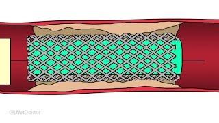 Stent: Das Metallgeflecht kann Leben retten - NetDoktor.de