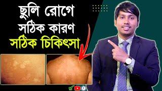 ছুলি রোগের চিকিৎসা | ছুলি দূর করার উপায় | ছলমের চিকিৎসা