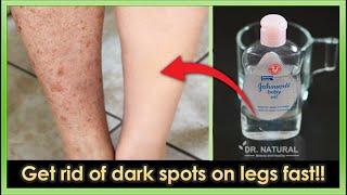 How to get rid of Dark spots, Scar, Mosquito Bites, Hyperpigmentation on legs fast.