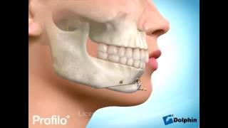 Chin Augmentation Surgery (Genioplasty)