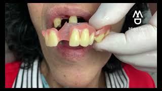 PRÓTESIS DENTAL FLEXIBLE (Una opción ideal) #viral #misterdent