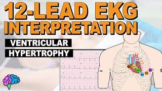 Ventricular Hypertrophy (LVH & RVH) on 12-Lead EKG