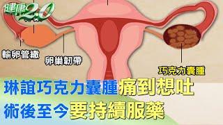 琳誼巧克力囊腫痛到想吐 術後至今要持續服藥 健康2.0