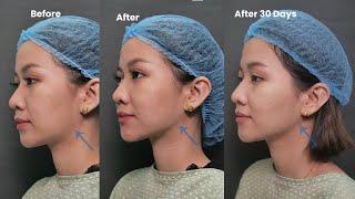 Female Jawline Definition | Dr. Contessa Salvador-Alapag