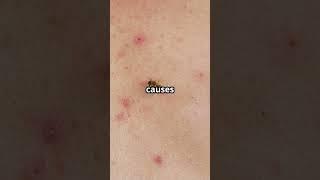 Why Mosquito Bites Itch: The Surprising Truth!