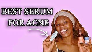 Best Toners & serums for Acne Prone Dark skin @PoirePosh