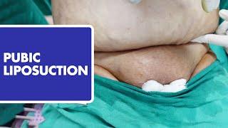 Female Pubic Fat Removal by Microaire #dezireclinic