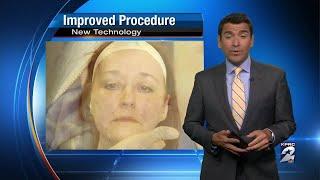 New facelift procedure