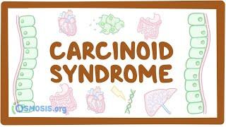 Carcinoid Syndrome - causes, symptoms, diagnosis, treatment, pathology