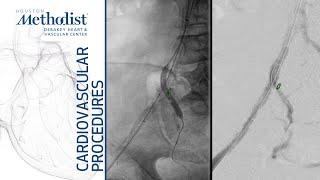 Internal Iliac Bifurcation VBX for Buttock Claudication (Alan Lumsden, MD, Ponraj Chinnadurai, MBBS)