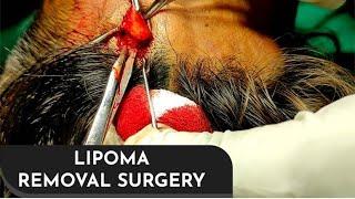 Forehead Lipoma Removal under local anesthesia by Dr. Prashant Yadav