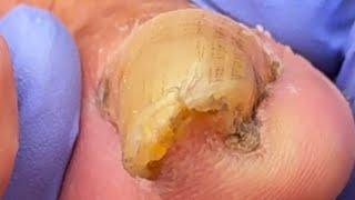 Ingrown Toenail Digs Deep Into Toe! Too Much Dead Skin【Podiatry Clinic】