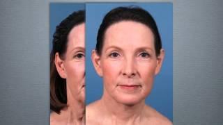 Neck Rejuvenation by DFW Plastic Surgeon Dr. Michael Bodgan