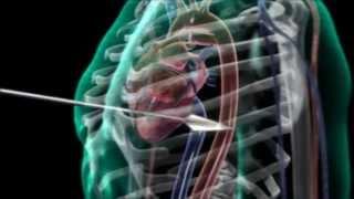 Arrow Through Human Heart - 3D Medical Animation || ABP ©