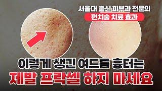 여드름흉터없애는법=프락셀? 아닙니다. ‘송곳형’ 여드름흉터 치료는 ‘펀치술’을 기억하세요.