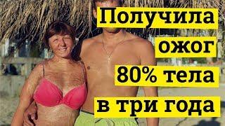 Наталья Устинова получила ожог 80% тела в три года