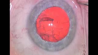 Dr. Steve Khachikian - Routine Cataract Surgery - Black Hills Eye Institute