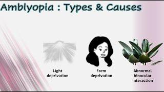 Amblyopia 1│ Types & causes