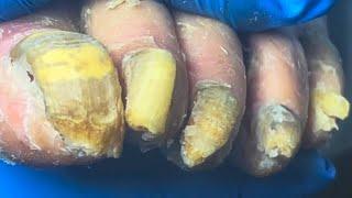 What A Long Yellow Onychomycosis, Like An Old Witch’S Long Nails!【Pedicure Master Lin Jun】