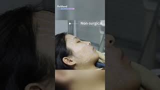 HIFU treatment｜non-invasive skin tightening & anti-aging #shorts #skincare #beautyclinic #wrinkles