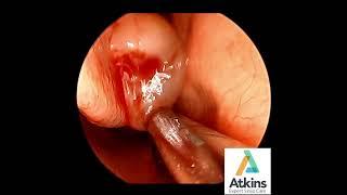 Right Nasal Polyp Removal With Shaver