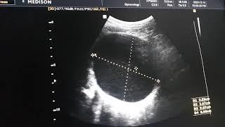 Bilateral Adnexal cystic Masses