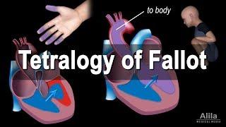 Congenital Heart Disease: Tetralogy of Fallot, Animation