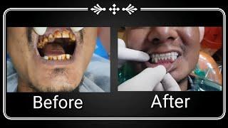 Transforming  the patient Smile to confident again.. 20 Teeth complete transformation