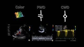 Spectral Doppler