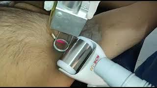 Fractional Carbon dioxide Laser for Acanthosis Nigricans