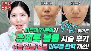 피부과 전문의의 쥬베룩 볼륨(레니스나) 셀프 시술 전후🫶ㅣ노남경의 피부클래스