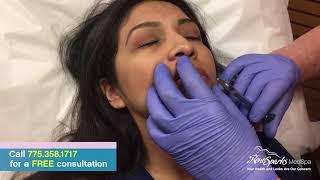 Juvederm Lip Injections Using a Cannula - Reno Sparks MedSpa - Dr. Calvin Van Reken