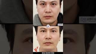 중안면부리프팅+하안검 전후비교