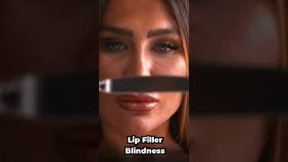 What is LIP FILLER BLINDNESS?? How it Happens