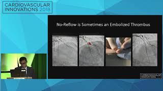 CVI2018 Session: Innovation in coronary thrombus management - Thomas Koshy, MD