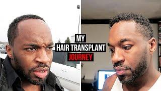 My Hair Transplant Journey | I AM RIO P.