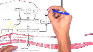 Burns - Pathophysiology