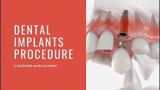 Dental Implant Procedure (Implants in Dubai)