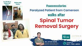 Paralyzed Patient from Cameroon walks after Spinal Tumor Removal Surgery #spinesurgery #successstory